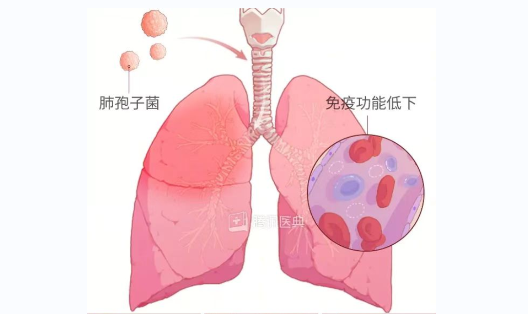 耶氏肺孢子菌肺炎—— 作为免疫缺陷病患者的常客，致死速度必须警惕！