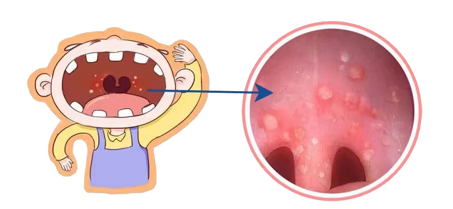高发期| 孩子高热、咽痛？疱疹性咽峡炎当心误治，谨防合并细菌感染！